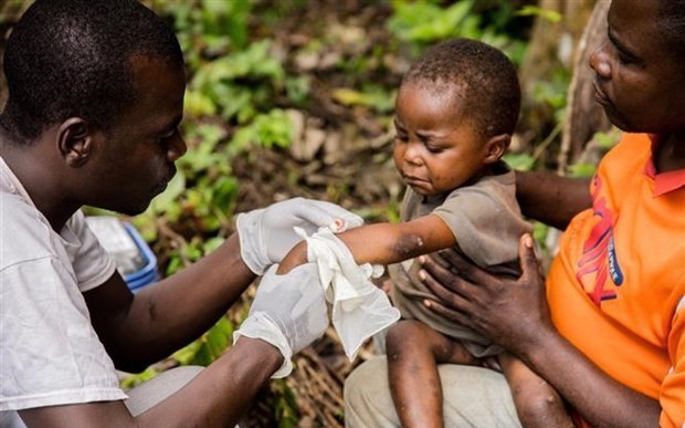 Điều trị cho bệnh nhân mắc bệnh đậu mùa khỉ. (Ảnh: AFP/TTXVN)
