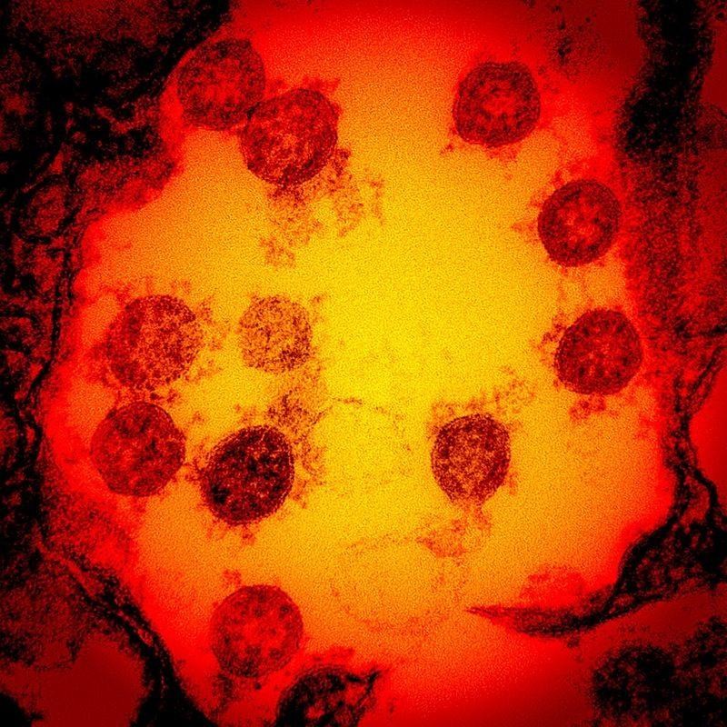 Ảnh vi điện tử được tăng cường màu chụp lại các hạt virus SARS-CoV-2 được phân lập từ mẫu bệnh phẩm của 1 bệnh nhân. (Ảnh: Viện Dị ứng và bệnh truyền nhiễm quốc gia Mỹ)