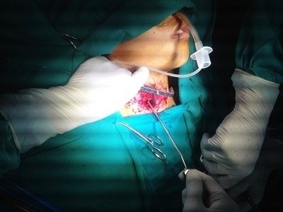 Phẫu thuật xử lý vết thương cho Nguyễn Viết Đức